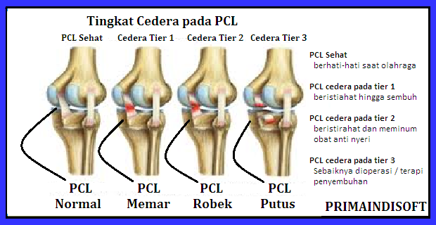 PCL | cedera pada ligamen terkuat